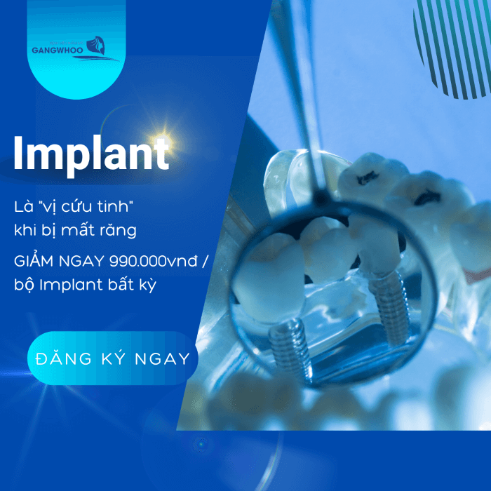 Review Cấy Ghép Implant Tại Địa Chỉ Uy Tín Chất Lượng