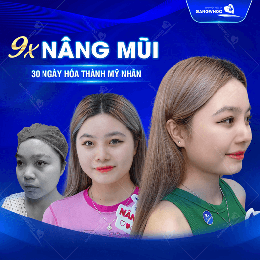 Từ 5 đến 7 ngày mũi sẽ hết sưng và sau 30 ngày mũi sẽ đẹp hoàn hảo