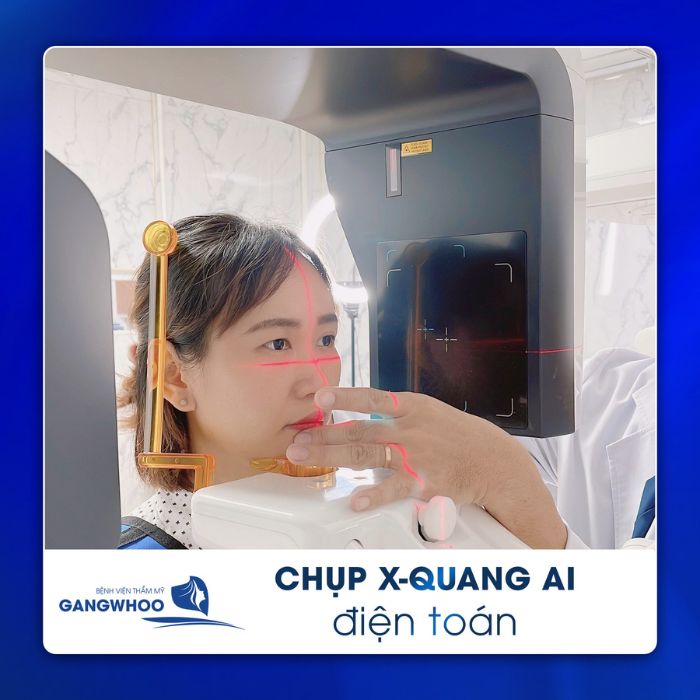 Ứng dụng công nghệ chụp X-Quang AI điện toàn vào nâng mũi