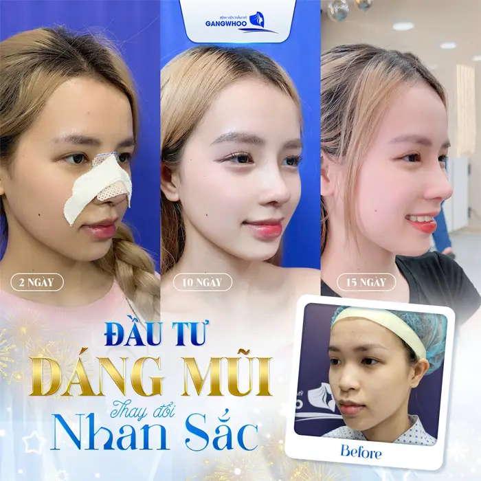 Gợi Ý 4 Cơ Sở Nâng Mũi Ở TPHCM