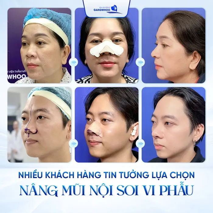 Bật Mí 3 Cơ Sở Nâng Mũi Ở Long An Đẹp Và An Toàn